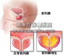 湖南性保健治疗前列腺增生