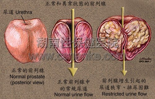 湖南性保健治疗前列腺医院