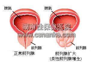 湖南治疗前列腺炎