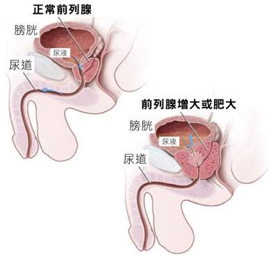 前列腺增生的异常症状