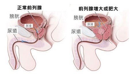 前列腺增生图