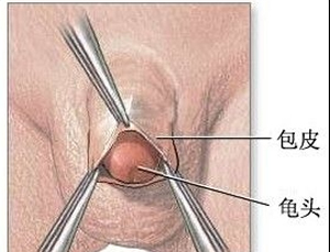 男人不能让雄风被“包”住