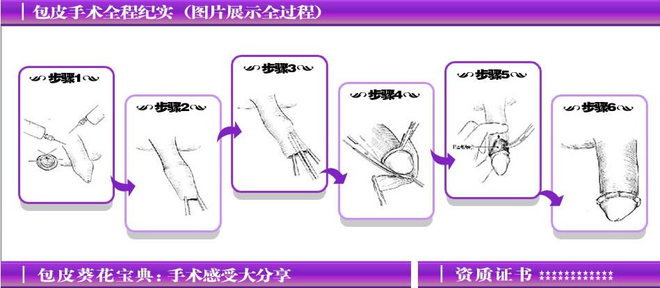 专家解析：包皮手术全过程