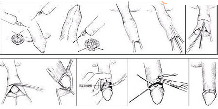 包茎手术后多久才能恢复？