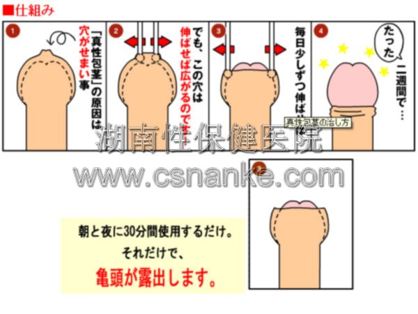 铜仁华南医院男科治疗包茎