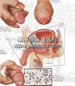 湖南治疗尿道炎医院