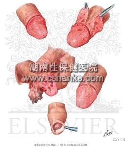 湖南性保健治疗龟头炎