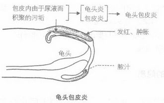 龟头炎