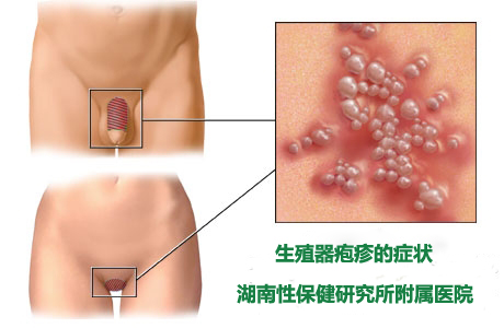 生殖器疱疹症状