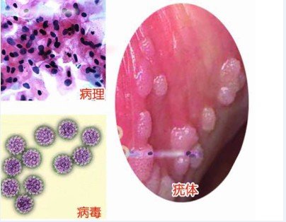 铜仁哪家医院看尖锐湿疣效果全国前三