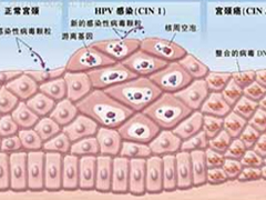 铜仁治疗尖锐湿疣哪里好