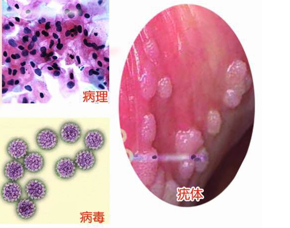 早期湿疣的治疗