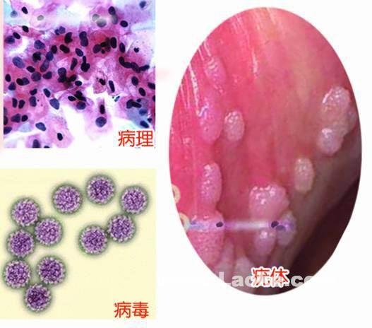 湖南治疗尖锐湿疣全国前三的医院