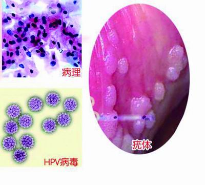 尖锐湿疣病理图