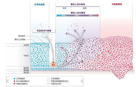 尖锐湿疣感染各阶段示意图