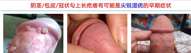 男性尖锐湿疣