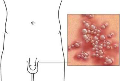 男性得了生殖器疱疹可以生育吗