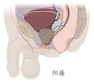 阳痿