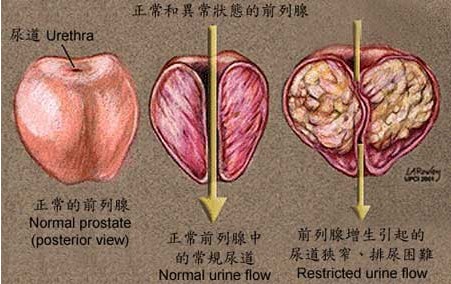 怎样治疗前列腺增生